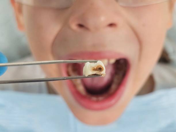 Best Emergency Tooth Extraction in Charleston, MS