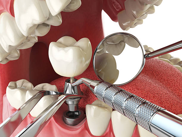 Best Emergency Root Canal Treatment in Charleston, MS