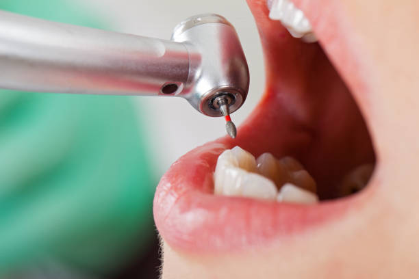 Best Emergency Treatment for Toothache in Charleston, MS